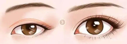 上瞼下垂整形前后對比 上瞼下垂整形前后對比