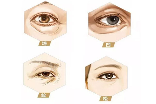 上眼皮松弛示意圖 上眼皮松弛示意圖