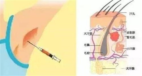 不手术去腋臭卡通图改善