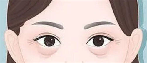 眼袋松弛和泪沟细纹展示图