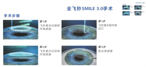 全飞秒3.0手术步骤