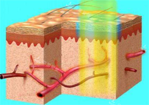 595染料激光治疗过程 595染料激光治疗过程