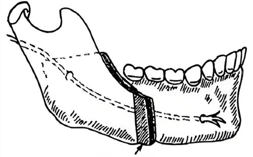 下颌垂直截骨术演示线条图 下颌垂直截骨术演示线条图