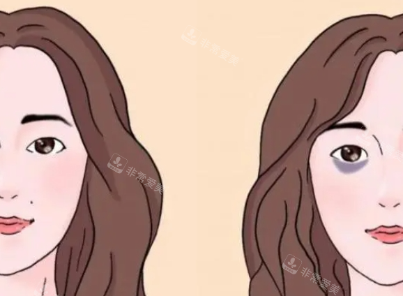 黑眼圈前后对比示意图