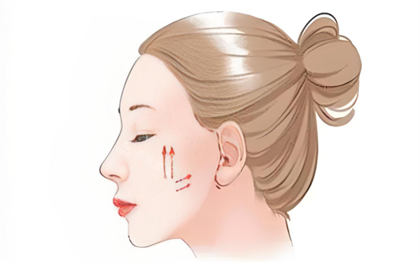 面部提升展示图 面部提升展示图