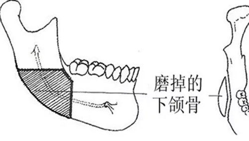 下頜外板位置示意圖