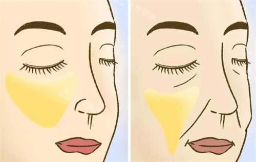 苹果肌提升前后对比