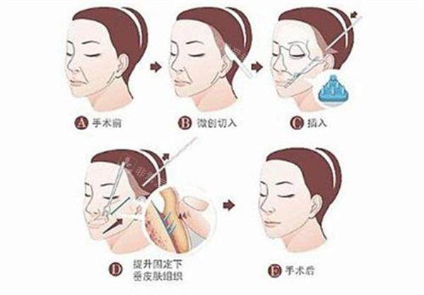 拉皮手术全过程