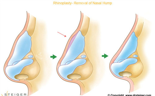 韓國做駝峰鼻矯正哪家...