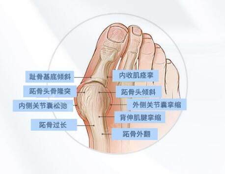 拇外翻原因分享