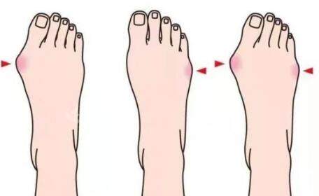 拇外翻卡通图照片