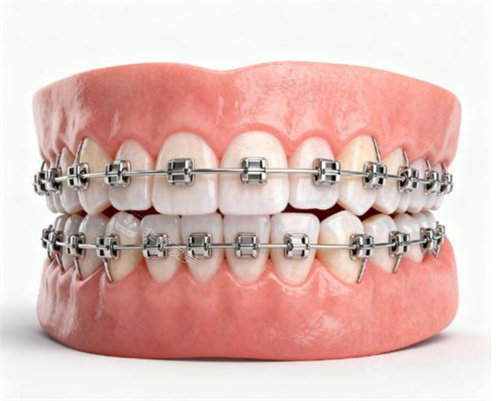 金属矫正牙齿模型图片