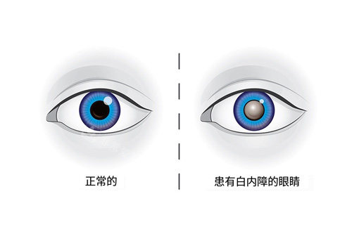 正常眼睛和患有白内障示意图