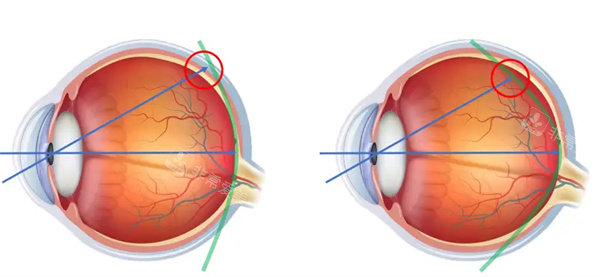 近视眼镜卡通对比