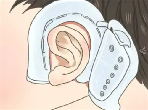 耳朵矫正器的形状