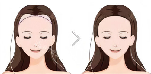 植发前后对比卡通图