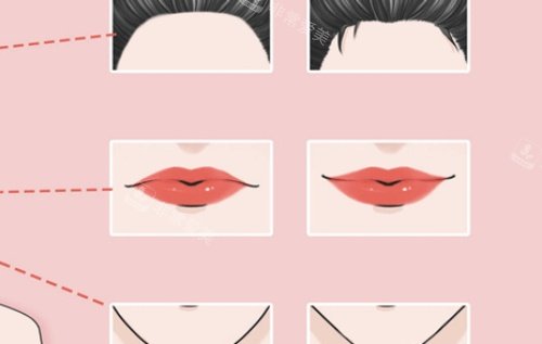 丰唇注射对比图