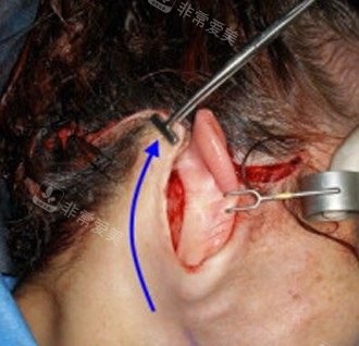 拉皮手术切口图