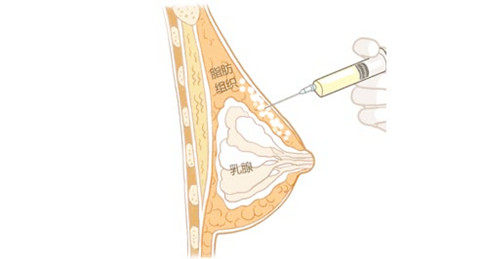 韩国做自体脂肪隆胸的二次填充：从“扁平”到“自信”的蜕变之旅