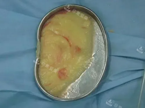 取出的奥美定实拍示意图