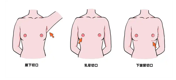 隆胸手术切口图