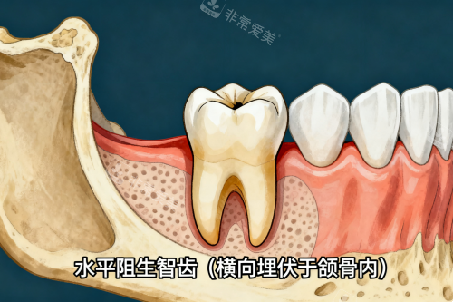 水平阻生智齿展示图