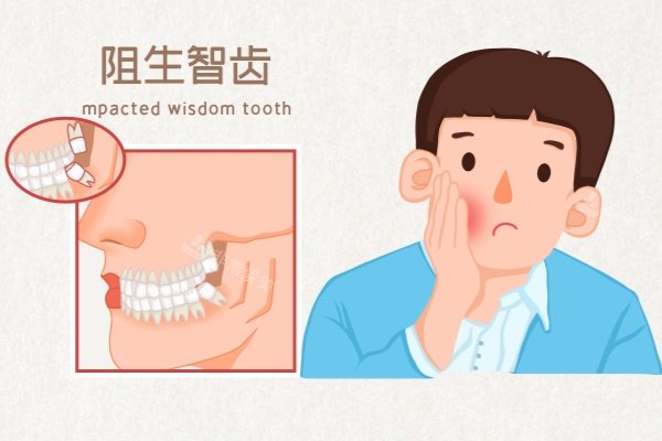 阻生智齿卡通展示图