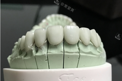 全瓷牙模型展示图