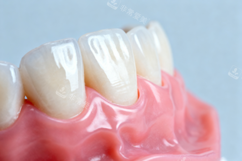 全瓷牙模型图