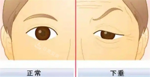 上睑下垂对比图