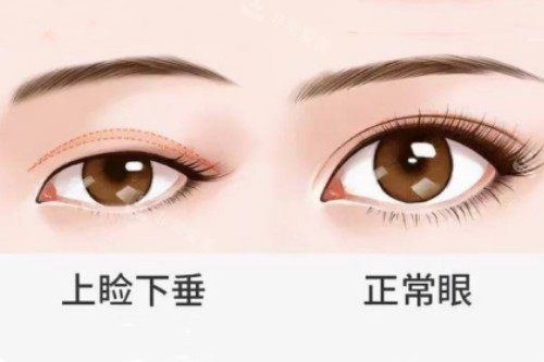 正常眼睛和上睑下垂眼睛对比图