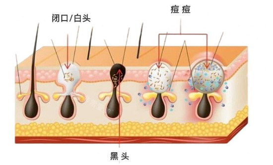 闭口黑头白头照片