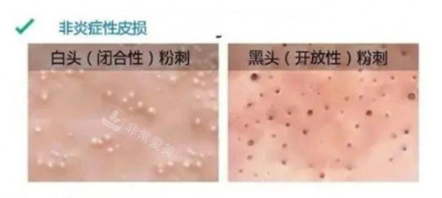 非炎症性闭口闭口黑口