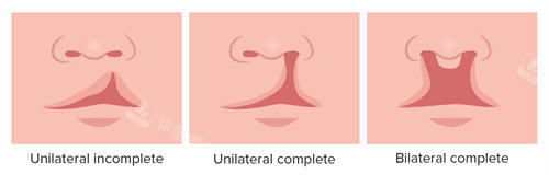 唇裂和唇腭裂不同程度 唇裂和唇腭裂不同程度