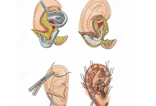 耳再造手术步骤展示