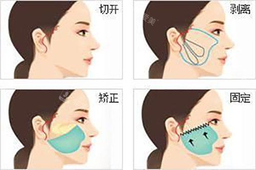 昆明博美医疗美容周杰小切口拉皮手术：切口隐蔽|修复时间快|适配轻中度松弛人群