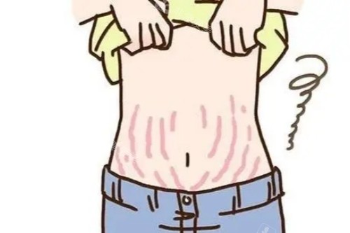 妊娠纹图片展示