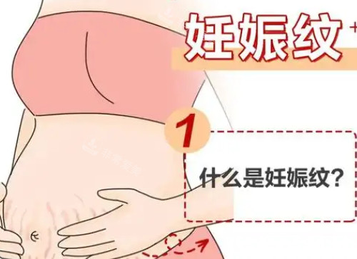什么是妊娠纹漫画图
