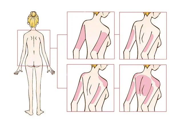 吸脂位置示意图1
