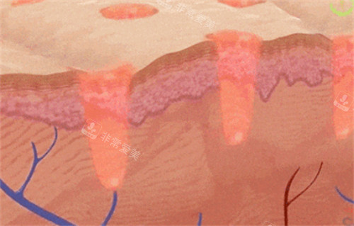 黑曜双波黄金微针治疗过程