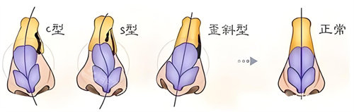 歪鼻矫正类型