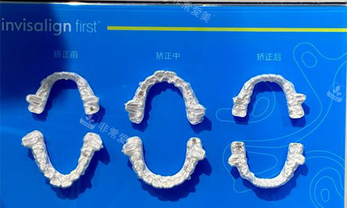 东莞好佰年口腔室外展示矫正成效对比图