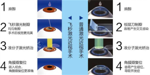 飞秒近视手术与激光近视手术的过程区别图解