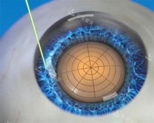 飞秒激光白内障手术图