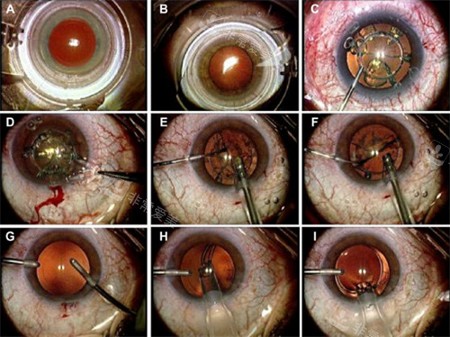 全飞秒手术过程图解