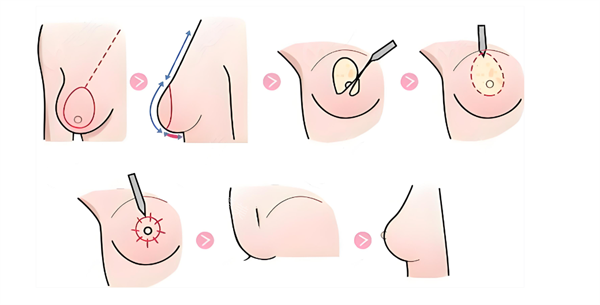 胸部下垂提升过程