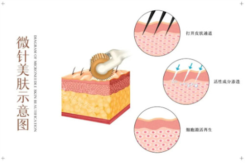 黑曜双波黄金微针是什么 黑曜双波黄金微针是什么