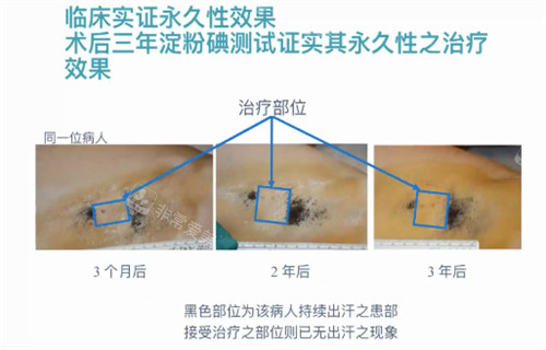 miraDry清新微波实例