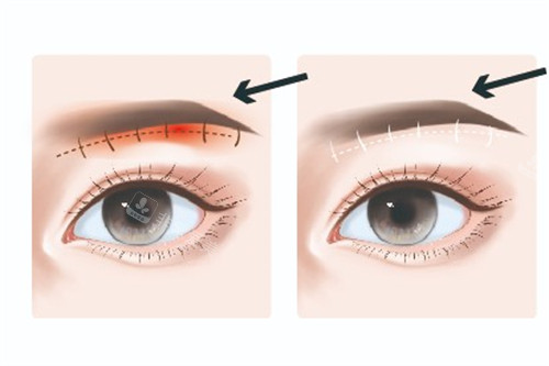 提眉術(shù)前術(shù)后對(duì)比動(dòng)畫(huà)圖