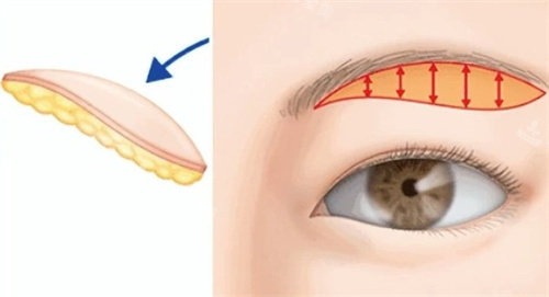 提眉手术切口 提眉手术切口